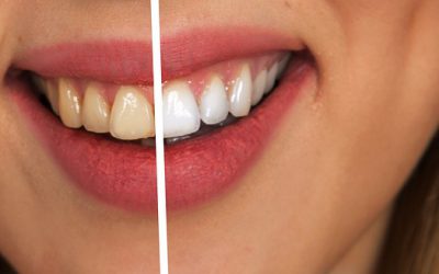 Wat zijn de gevaren van zelf je tanden bleken?